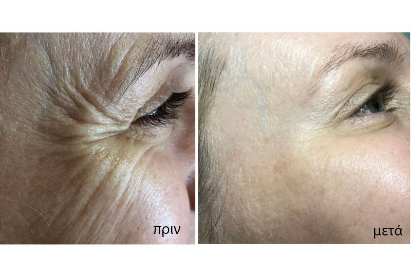 botox botox